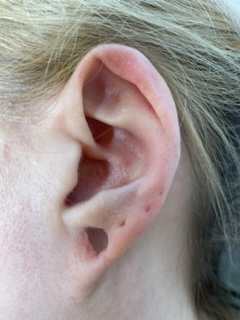 Gauged earlobe