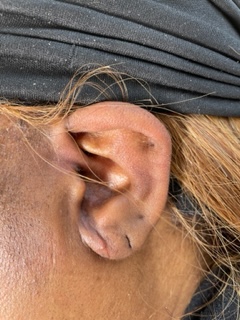 After photo of completely torn earlobe repair