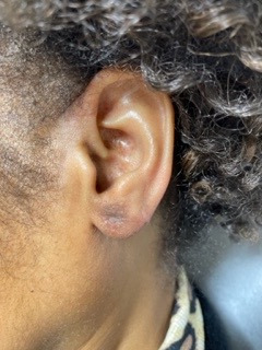 After photo of torn earlobe repair