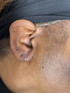 After photo from stretched earlobe repair