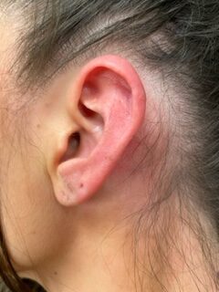 After photo of cartilage keloid removal from ear