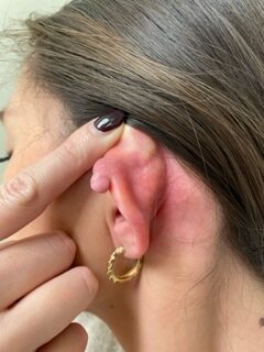 Keloid from cartilage peircing