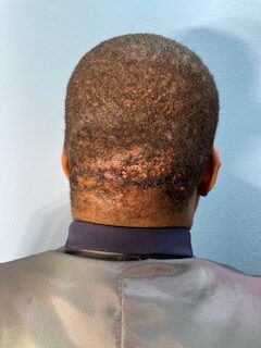 After photo of large keloid removal from back of head