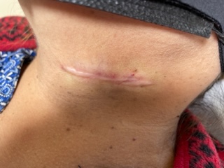 After photo of keloid removal on neck