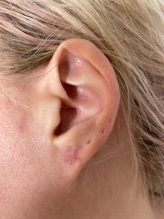 After of gauged earlobe repair