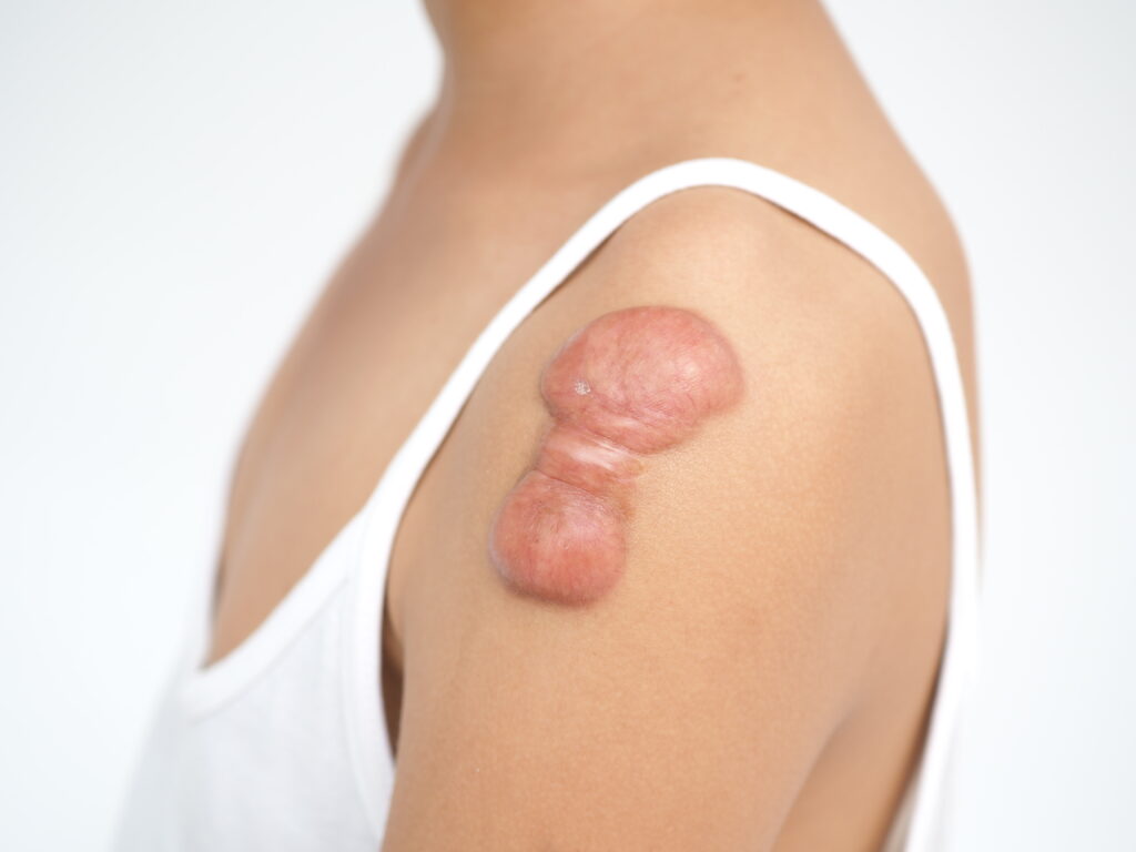 keloids and keloid scar on woman's shoulder area