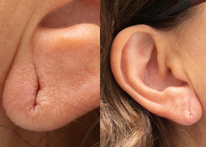 torn earlobe of older woman from heavy earrings